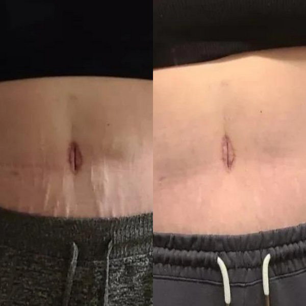 Avant / Après de Lola S.