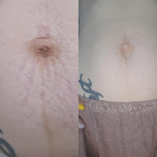 Avant / Après de Aude P.