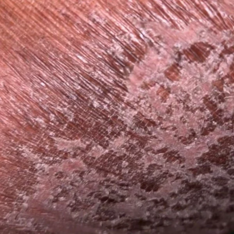 Jour 15 : Exfoliation