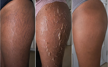 Pack: Cuidado revitalizante para estrías