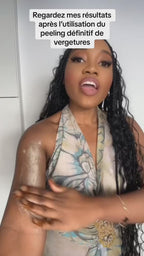 Black soap peeling anti-stretch marks