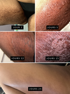 Black soap peeling anti-stretch marks